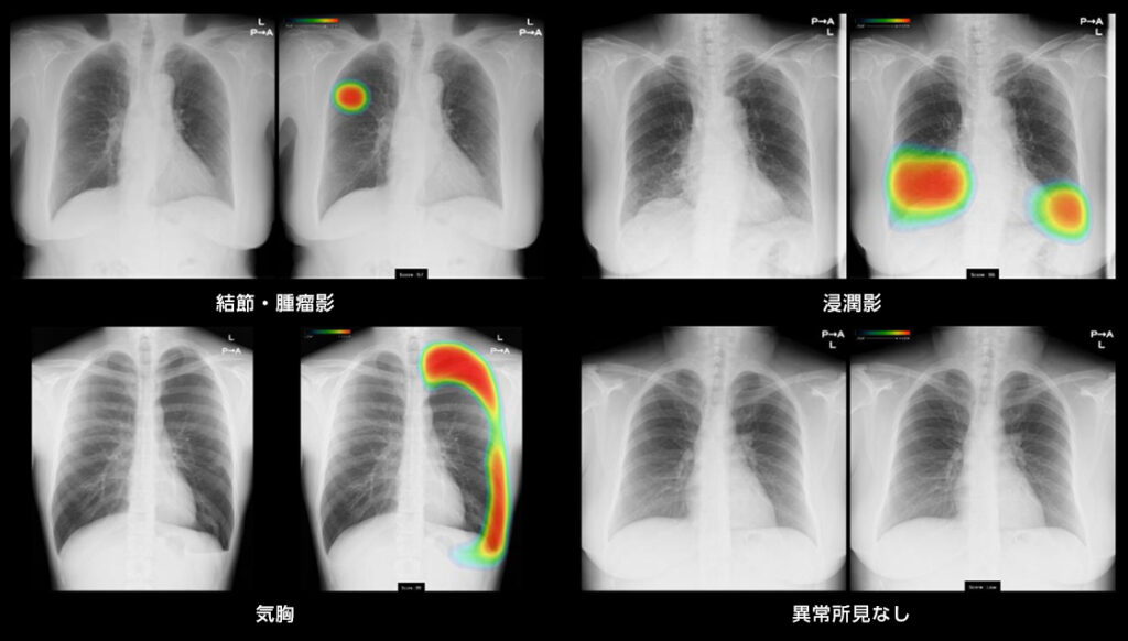 富士フイルム株式会社「胸部X線画像病変検出ソフトウェア CXR-AID」を導入しました。AIのこと。がんのこと。